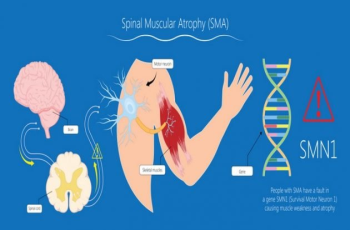 Spinal Muscular Atrophy: What you need to know