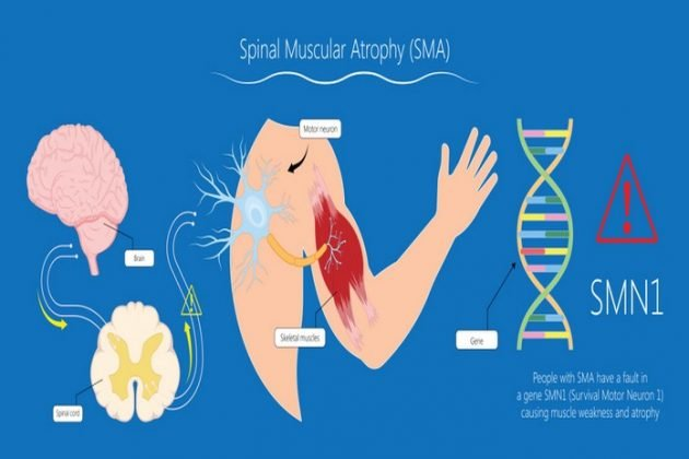 Spinal Muscular Atrophy: What you need to know - SQQLP